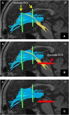 Aberrant Anterior Thalamic Radiation Structure in Bipolar Disorder: A Diffusion Tensor Tractography Study